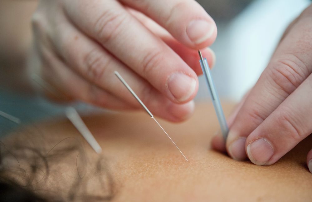 Akupunktur i København ved professionel behandler